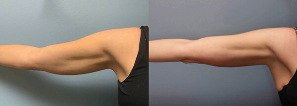 1764956446_fat-removal-body-sculpting-2 1764956446 fat removal body sculpting 2 1