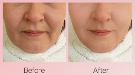 Before and After Image: Renaface® - front