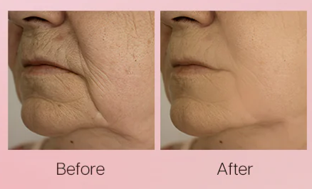 Before and After Image: Renaface® - front