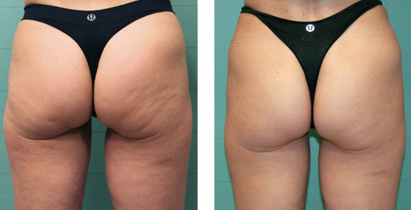 Before and After Image: Body Sculpting - back