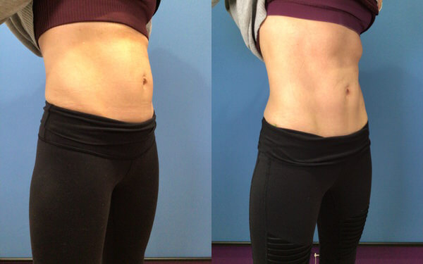 Before and After Image: Body Sculpting - right-front-oblique