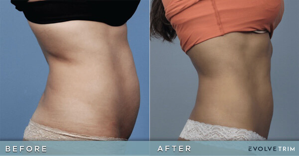 Before and After Image: Body Sculpting - right-side