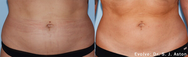 Before and After Image: Body Sculpting - front