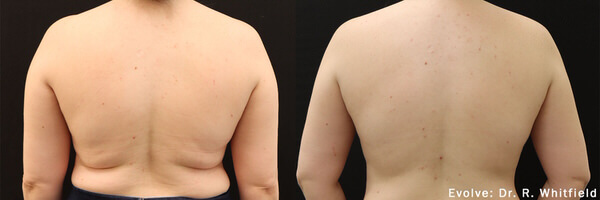 Before and After Image: Body Sculpting - back