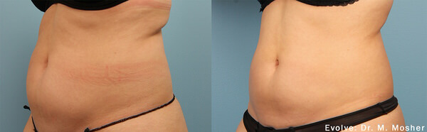 Before and After Image: Body Sculpting - left-front-oblique